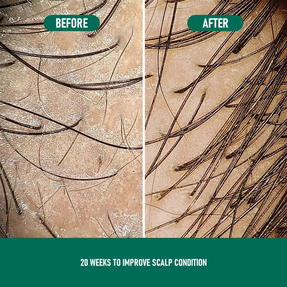 CH004 Minoxidil Anti-Hair Loss Mousse aerosol can, 60g, for topical scalp application.