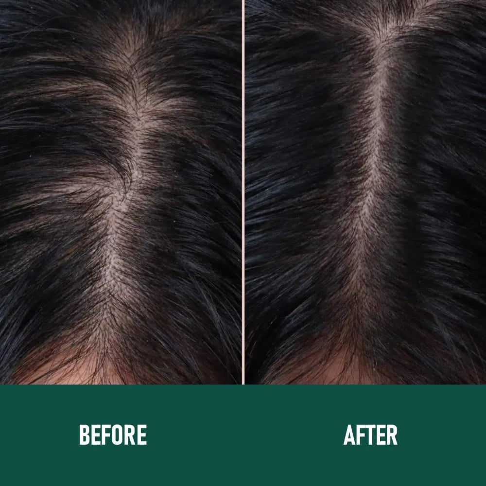 CH004 Minoxidil Anti-Hair Loss Mousse aerosol can, 60g, for topical scalp application.