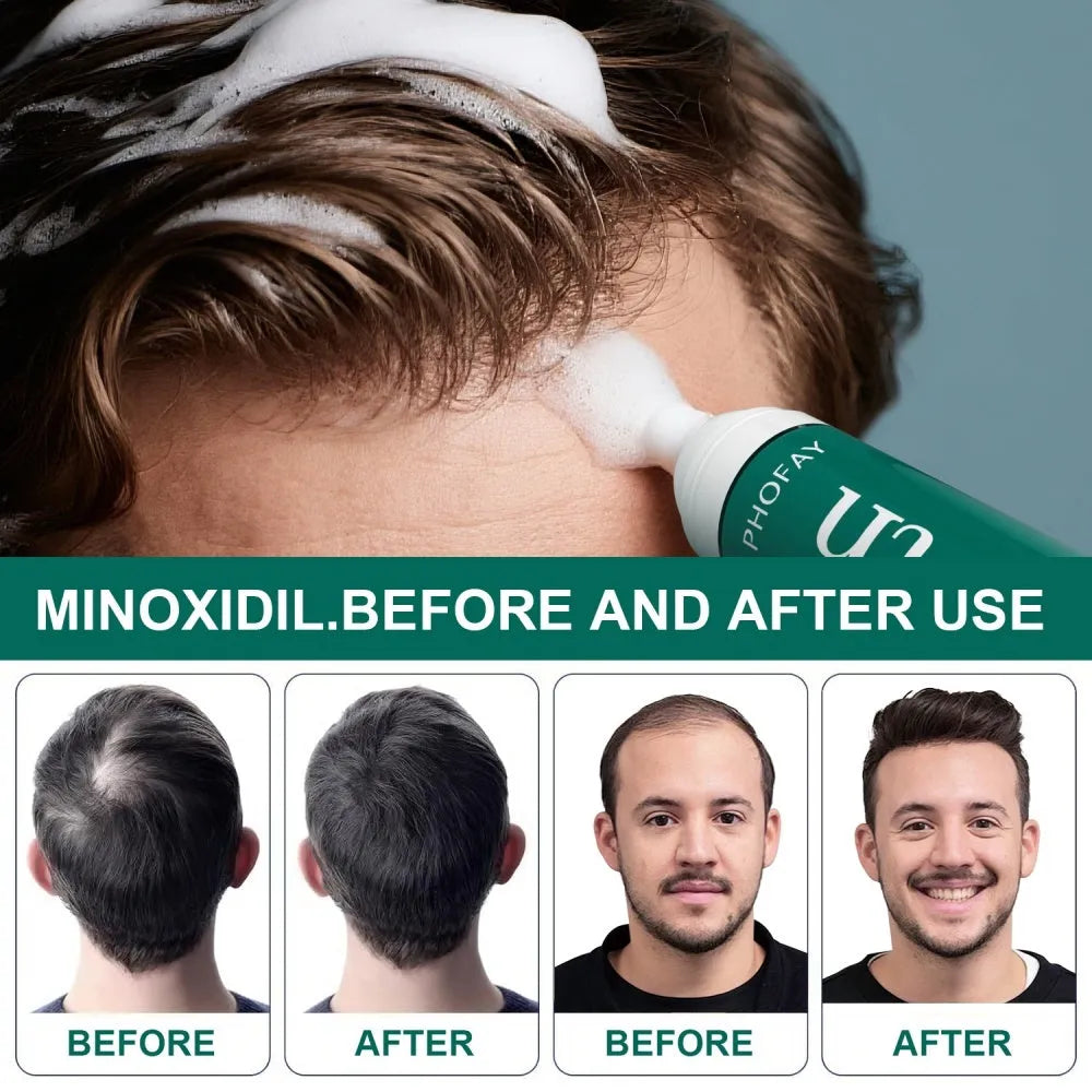 CH004 Minoxidil Anti-Hair Loss Mousse aerosol can, 60g, for topical scalp application.