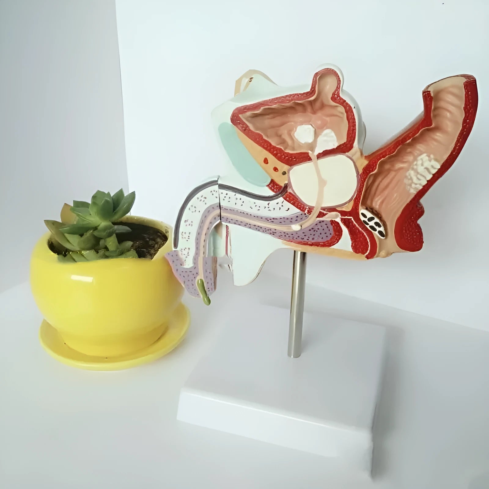 Plastic anatomical model showing male internal reproductive system diseases including benign prostatic hyperplasia.