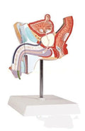 Plastic anatomical model showing male internal reproductive system diseases including benign prostatic hyperplasia.