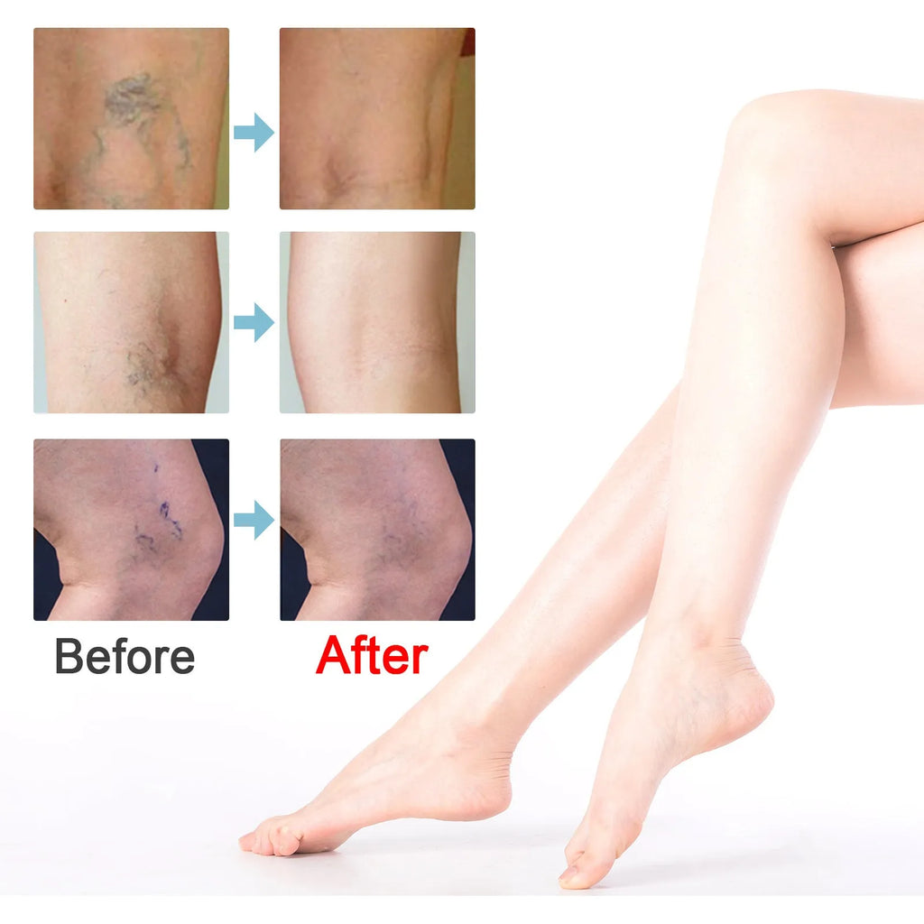 20g vein repair cream container for leg vein treatment and green tendon bulge relief