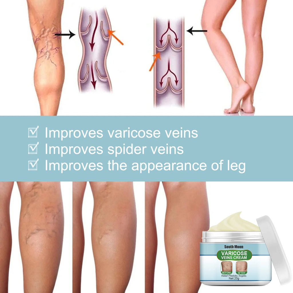 20g vein repair cream container for leg vein treatment and green tendon bulge relief