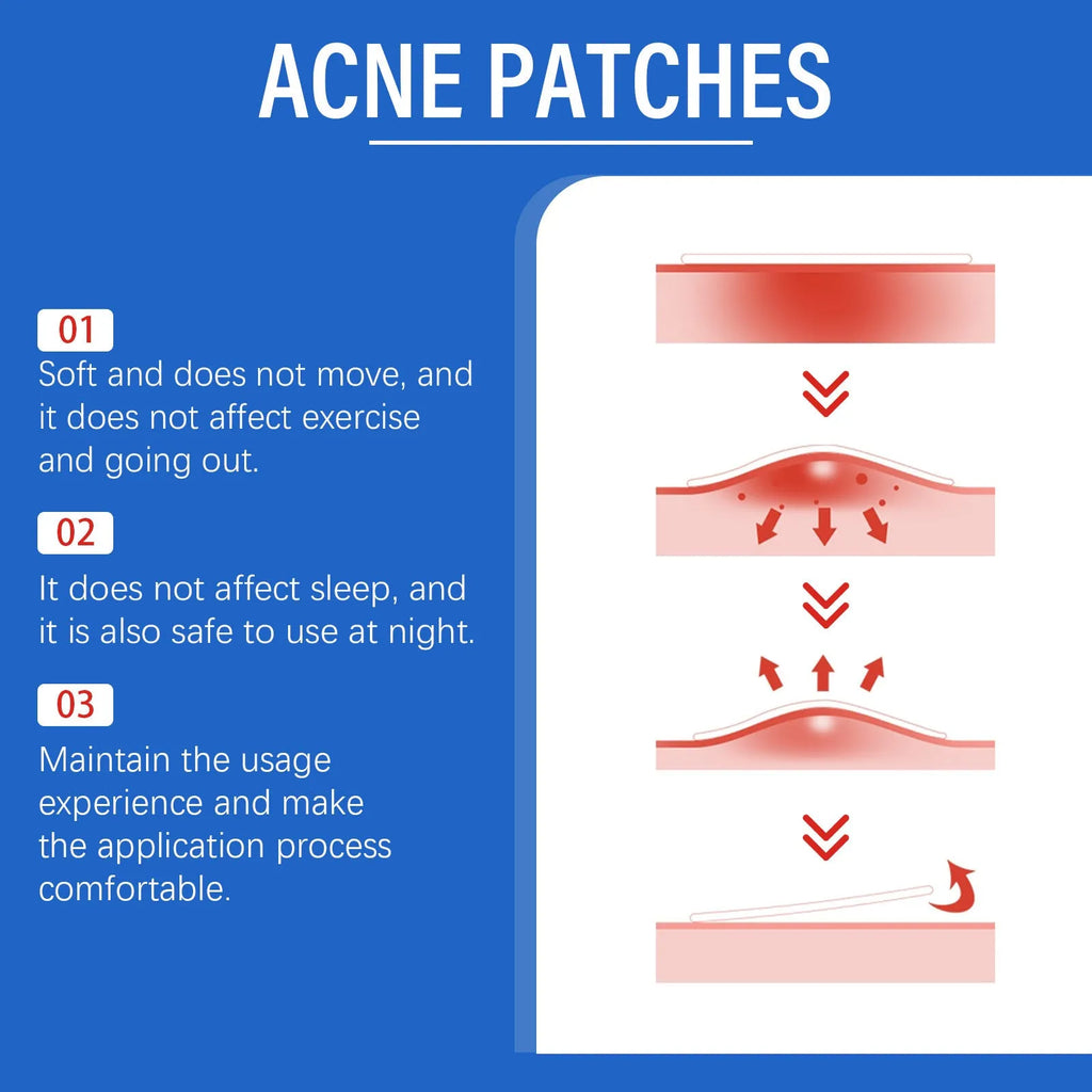 Box of 216 hydrocolloid acne patches with tea tree oil and vitamin E for spot treatment