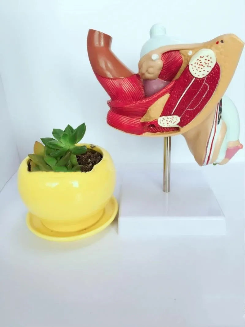 Plastic anatomical model showing male internal reproductive system diseases including benign prostatic hyperplasia.