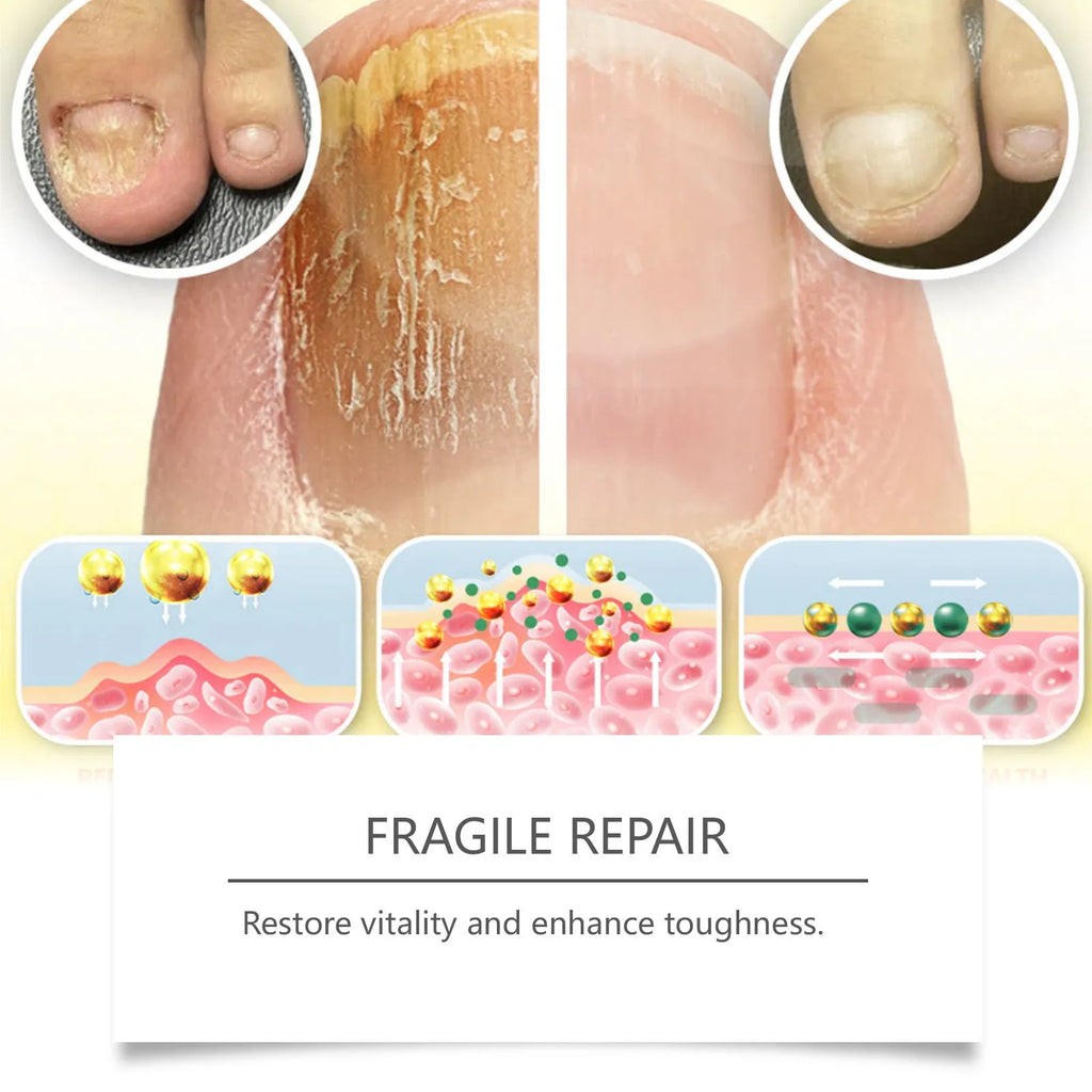 50ml bottle of nail fungus treatment solution with bee venom and peppermint oil